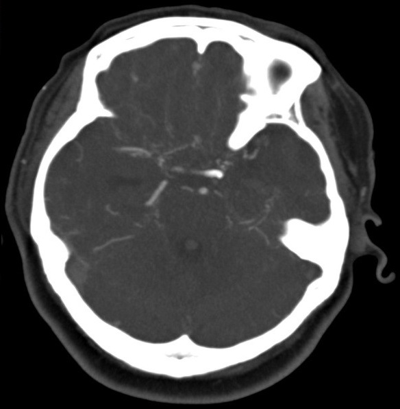 CT angiogram of the Circle of Willis (1)